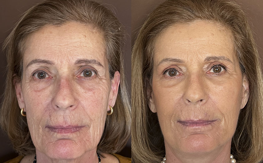 Caso Lifting Deep Plane — resultado antes y después